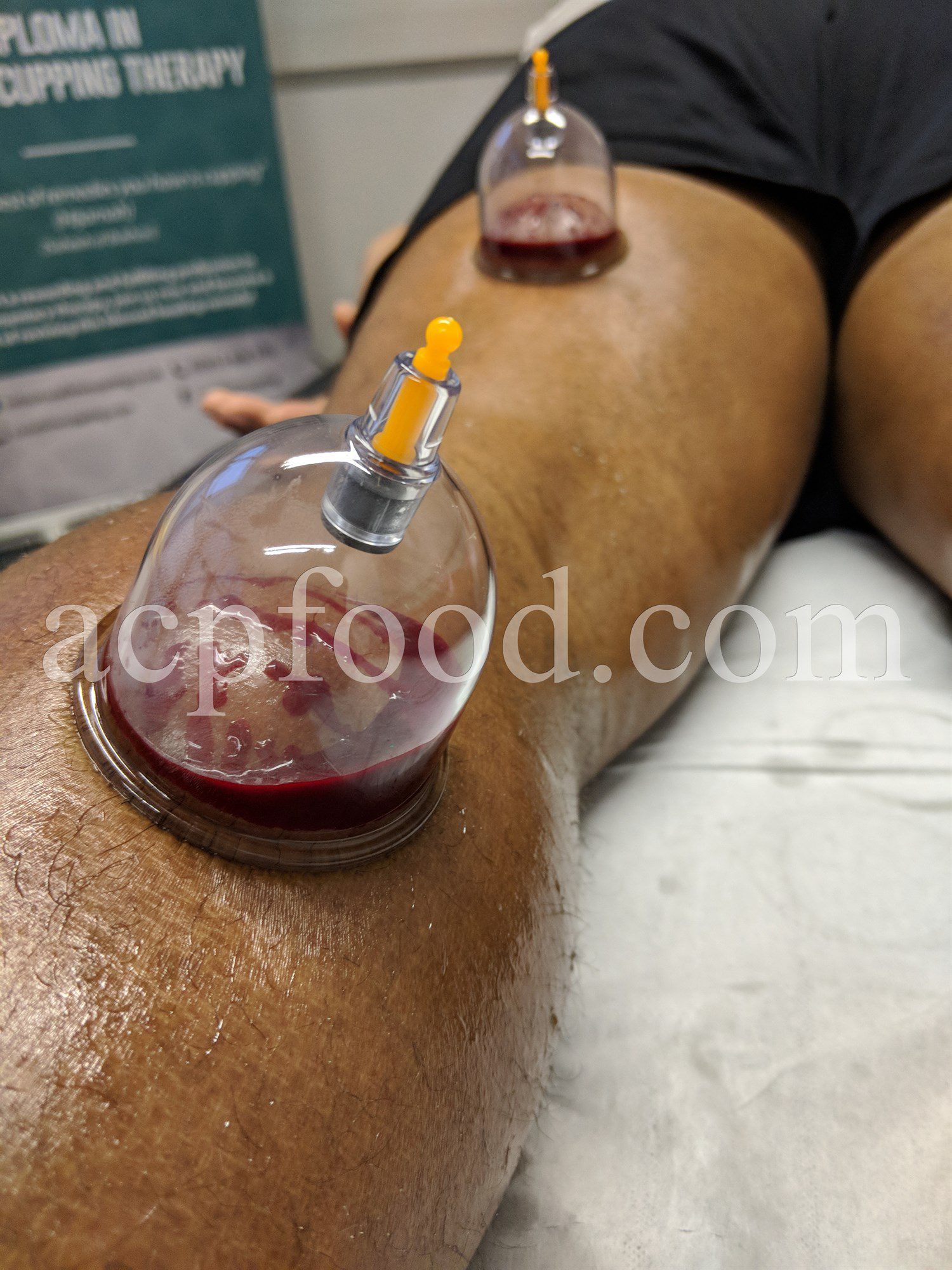 Hijama. Wet hijama. Wet cupping