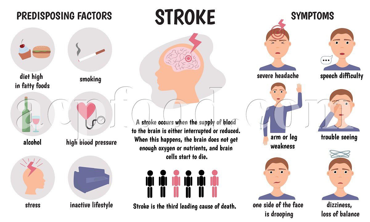 Brain Stroke causes, symptoms, and treatments. How to prevent a brain stroke?