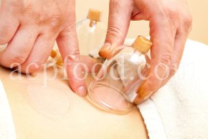 Cupping Therapy