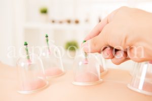 Cupping Therapy