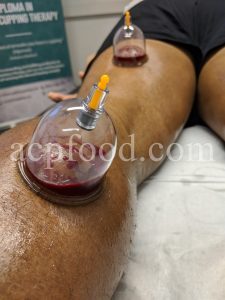 Hijama (Wet Cupping)